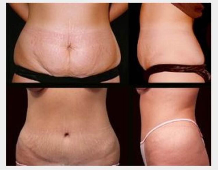 Step-by-Step Guide in Performing Tummy Tuck Procedure