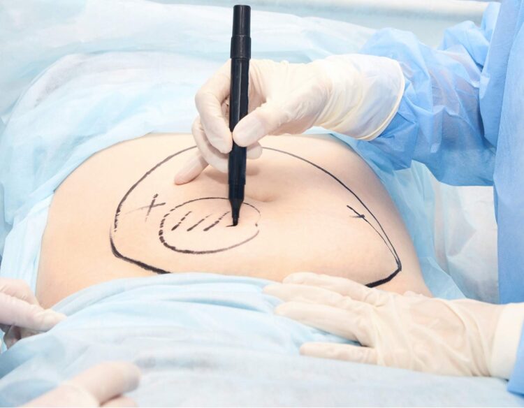 How to Decide If You Should Get a Tummy Tuck – 7 Tips