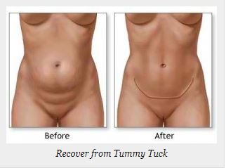 Tummy Tuck Recovery tips