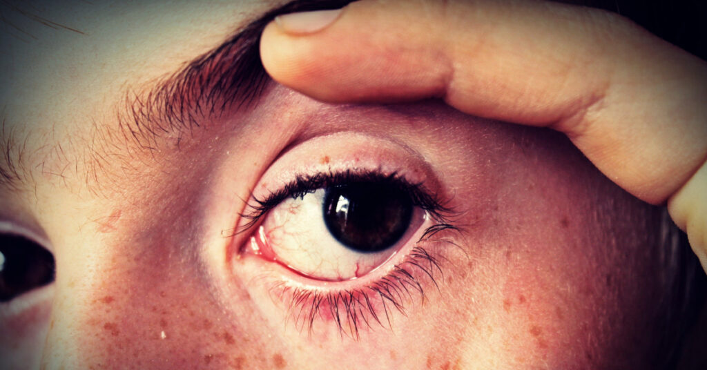 Why does Your Eyes Hurt When You Blink? How Bad is it?